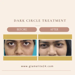 Dark Circle Treatment