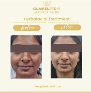 Hydra Facial Treatment in Hinjewadi